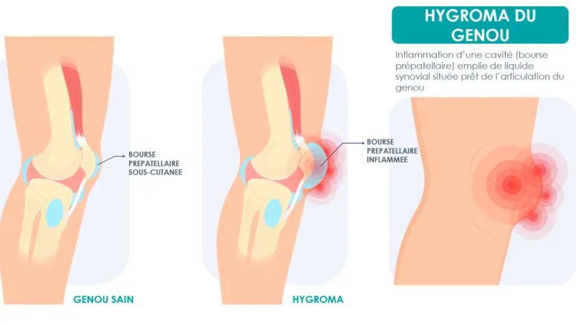 hygroma-genou