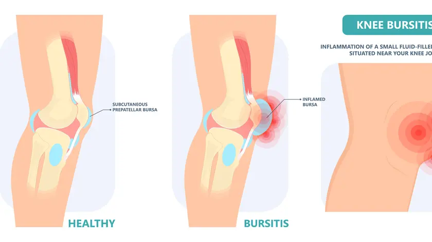 knee hygroma protection elis